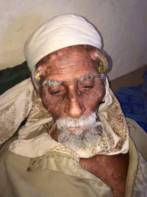 130 yaşlı qoca "buynuz" əməliyyatından sonra ÖLDÜ - FOTO