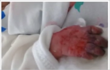 Azərbaycanda 3 aylıq körpənin barmaqları həkim səhvinə qurban getdi - FOTOLAR