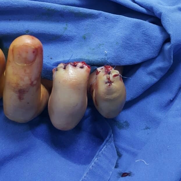 Bakıda əlində pirotexniki vasitə partladı… - Ürəyi zəiflər baxmasın/Fotolar