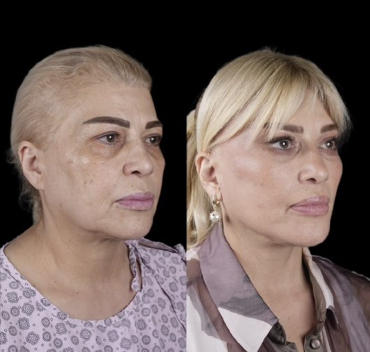 Mətanət İsgəndərli əməliyyatla belə dəyişdi - Fotolar