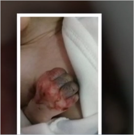 Azərbaycanda 3 aylıq körpənin barmaqları həkim səhvinə qurban getdi - FOTOLAR