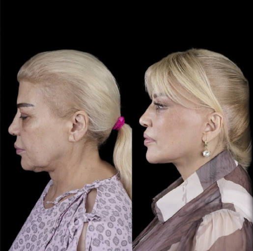 Mətanət İsgəndərli əməliyyatla belə dəyişdi - Fotolar