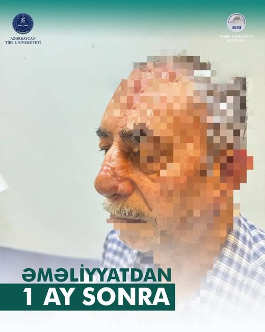 İt dişləməsi nəticəsində burnunu itirən xəstəyə yeni burun formalaşdırıldı - Azərbaycanda unikal əməliyyat