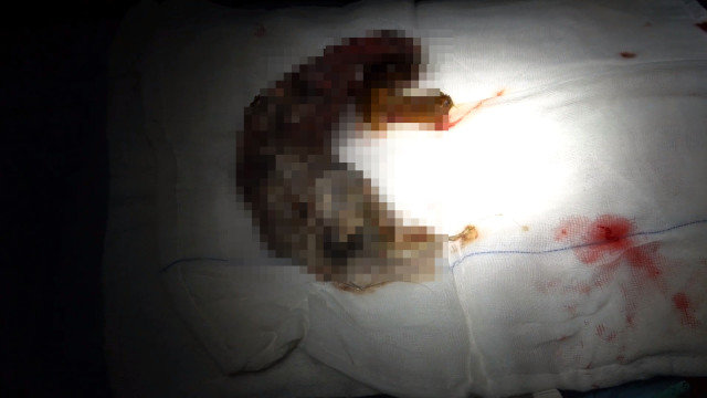 11 yaşlı qızın mədəsindən çıxanlar həkimləri şok etdi - FOTOLAR