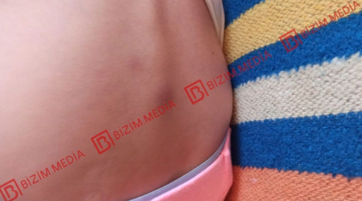 Lənkəranda qandonduran HADİSƏ – Ana isti qaşıqla 3 yaşlı qızının qolunu DAĞLADI