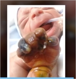 Azərbaycanda 3 aylıq körpənin barmaqları həkim səhvinə qurban getdi - FOTOLAR