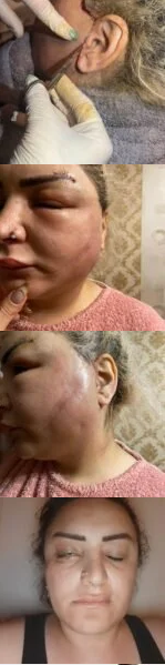 Lalə Mirzəyeva pasiyenti bu hala saldı-Fotofakt