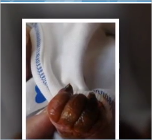 Azərbaycanda 3 aylıq körpənin barmaqları həkim səhvinə qurban getdi - FOTOLAR