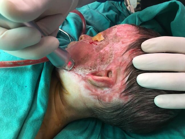 ÜRƏYİ ZƏİF OLANLAR BAXMASIN! Benzin tökülərək yandırılan 2 yaşlı uşağın FOTOLARI