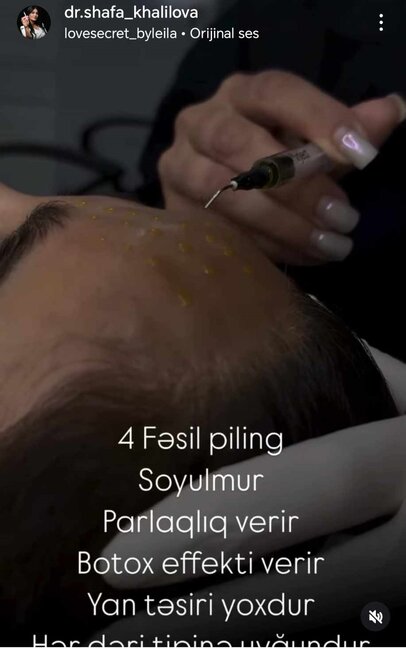 Şəfa Xəlilova dolğu,inyeksiya, botox prosedurlarını necə icra edir? -Fotofaktlar