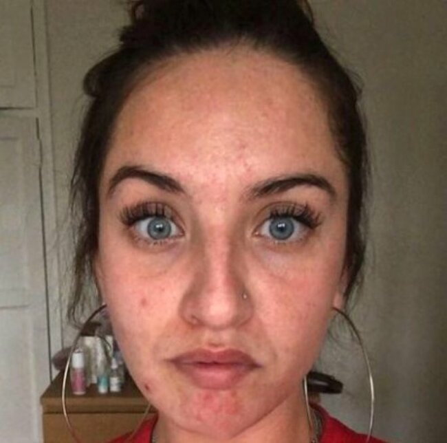 Üzündə ləkələr yaranan 29 yaşlı qadın həkimə getdi, eşitdiklərindən şoka düşdü - FOTOLAR