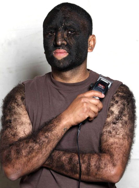 Dünyanın ən tüklü insanı - Hamı ondan danışır - FOTOLAR