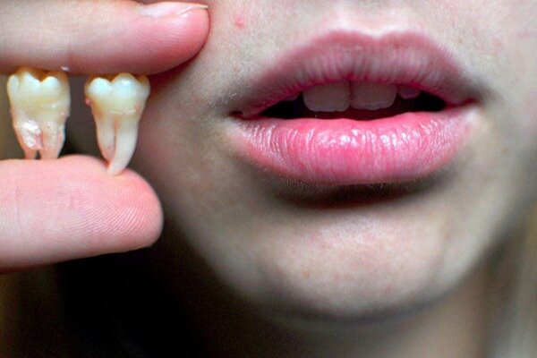 Korona diş tökülməsinə səbəb olur - Araşdırma