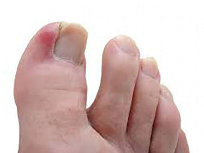 Onixokriptoza daha çox ayağın baş barmağında rast gəlinir