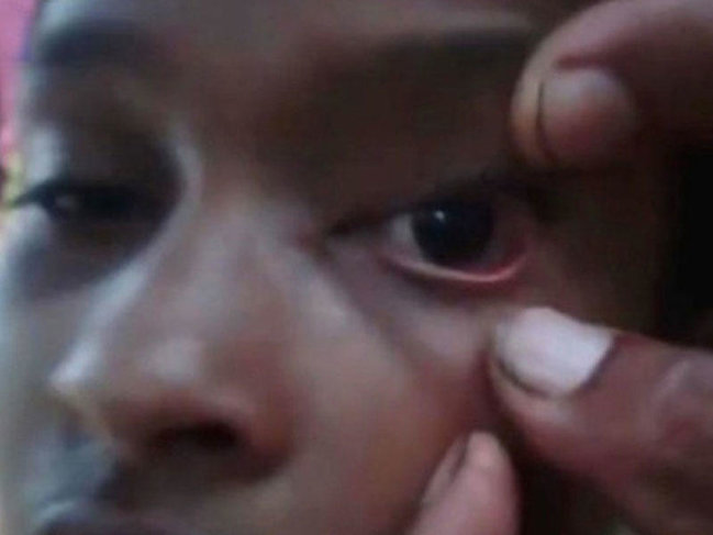 11 yaşlı qızın gözlərindən qarışqa çıxır - Haradan gəldiyi ŞOK ETDİ - VİDEO