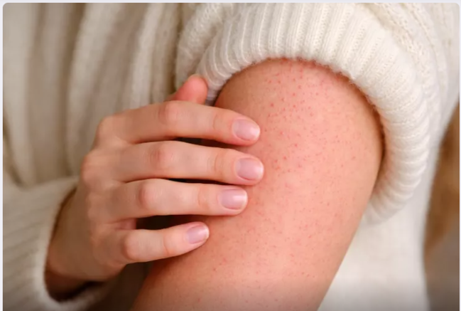 Niyə qışda əllərdə qırmızı xırda qabarcıqlar yaranır?