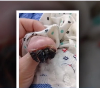 Azərbaycanda 3 aylıq körpənin barmaqları həkim səhvinə qurban getdi - FOTOLAR