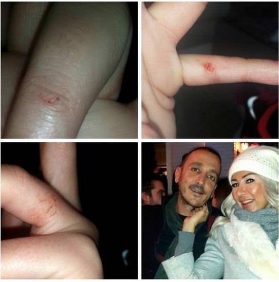 Nazlı Hamarat sevgilisi tərəfindən döyüldü - FOTO