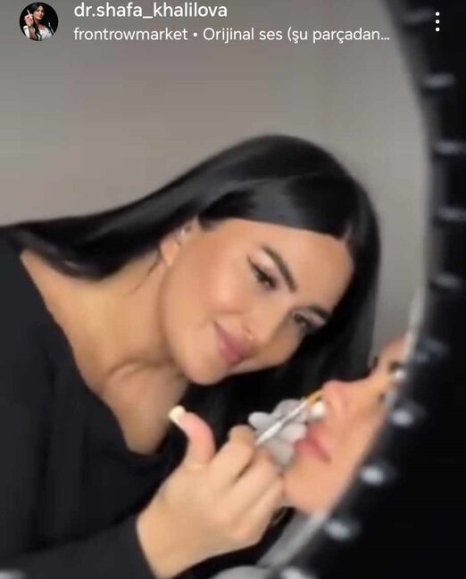 Şəfa Xəlilova dolğu,inyeksiya, botox prosedurlarını necə icra edir? -Fotofaktlar