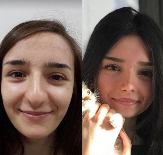 BURUN insan üzünü BELƏ DƏYİŞİR - FOTOLAR