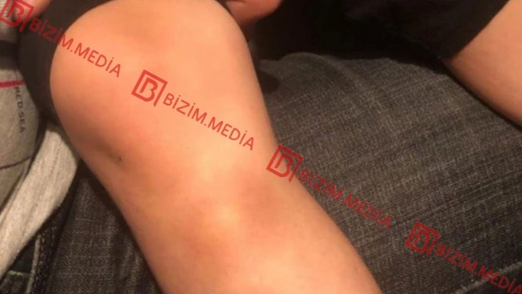 Lənkəranda qandonduran HADİSƏ – Ana isti qaşıqla 3 yaşlı qızının qolunu DAĞLADI