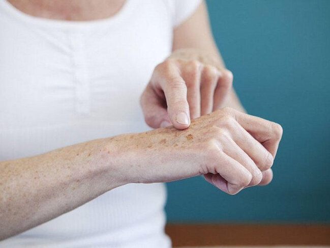 Qəhvəyi ləkələrin sirri - Müalicəsi varmı?