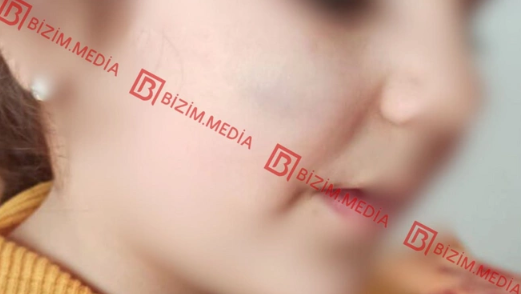 Lənkəranda qandonduran HADİSƏ – Ana isti qaşıqla 3 yaşlı qızının qolunu DAĞLADI