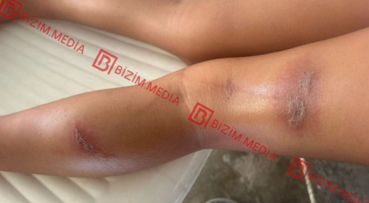 Lənkəranda qandonduran HADİSƏ – Ana isti qaşıqla 3 yaşlı qızının qolunu DAĞLADI