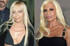 Dünyaca məşhur ulduzların uğursuz plastik əməliyyatları - FOTO