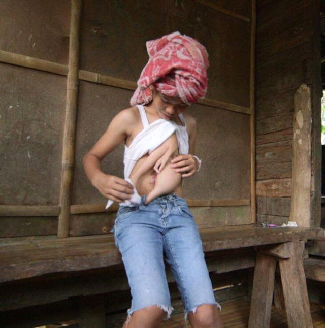 14 yaşlı qız ona bitişik olan əkizinin bədənini daşıyır - FOTOLAR