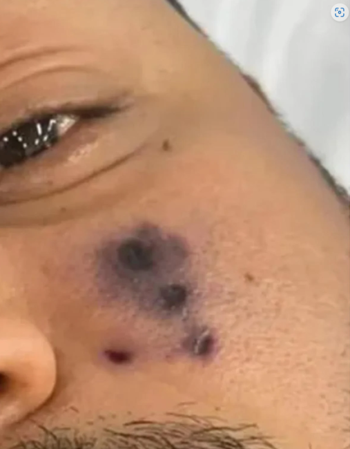 Hörümçək dişləyən məşhur müğənni öldü - VİDEO