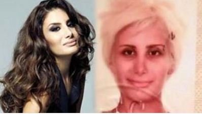 İrem Derici estetik əməliyyatdan əvvəl və sonra - FOTO