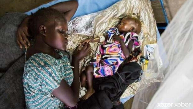 Yeni xəstəlik yayılır: 5 yaşa qədər olan uşaqları hədəf alır - Artıq 165 uşaq ölüb