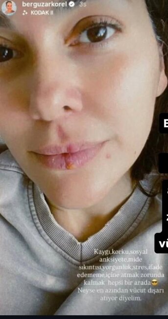 Bergüzar Korel makyajsız və sızanaqlı üzünü paylaşdı - FOTO