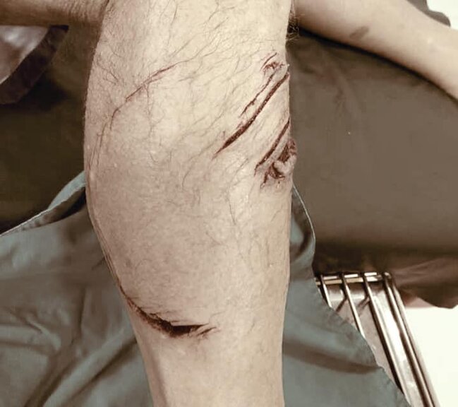 Bulanıq suda üzən turistin ayağını köpəkbalığı dişlədi - DƏHŞƏTLİ FOTO