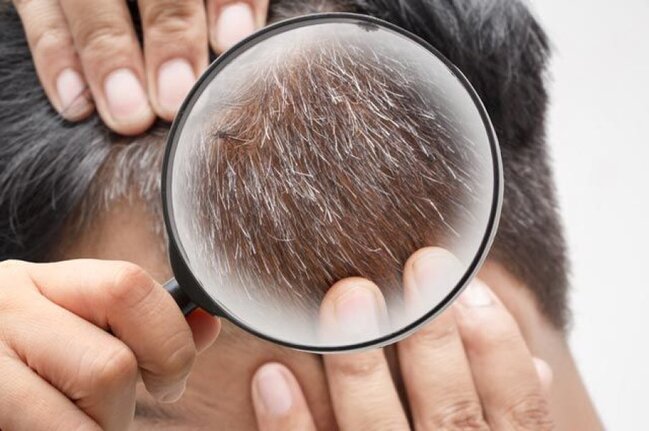 Erkən saç ağarmasının səbəbləri