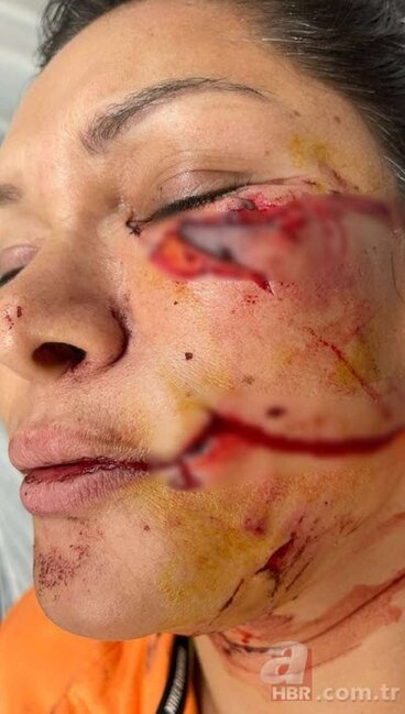 İt müğənniyə hücum edib, tanınmaz hala saldı