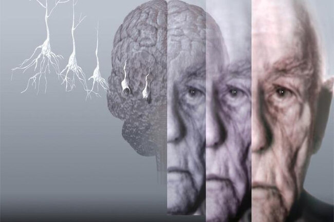 Alzheimer xəstəliyinin yeni səbəbi TAPILDI