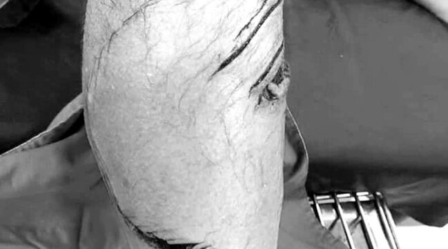 Bulanıq suda üzən turistin ayağını köpəkbalığı dişlədi - DƏHŞƏTLİ FOTO