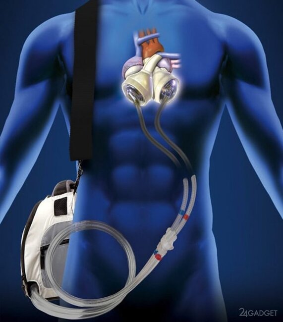 Kürəyində süni ürəklə 555 gün yaşadı - FOTO-VİDEO