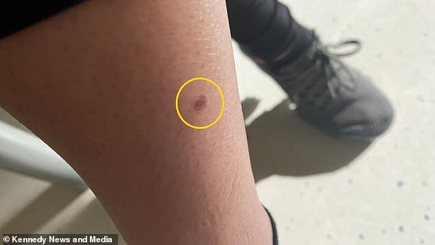 3 ay solariuma getdi, ayağındakı kiçik xal BU HALA DÜŞDÜ - DƏHŞƏTLİ FOTOLAR