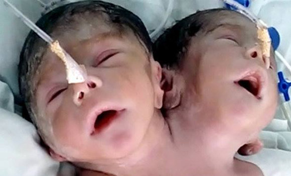 Hindistanda dəhşət — İkibaşlı uşaq doğuldu - FOTOLAR