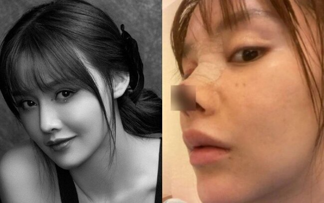 25 yaşlı aktrisanın burnu çürüyür