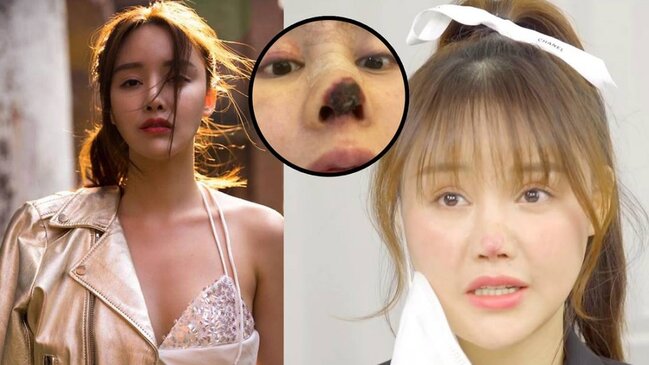 25 yaşlı aktrisanın burnu çürüyür