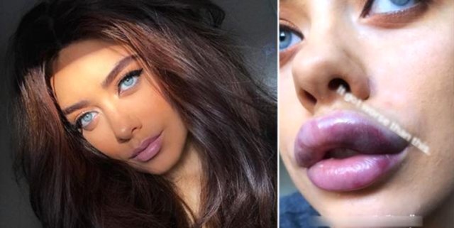 Cəzbedici gözəl estetik əməliyyatla görün nə günə düşdü? /FOTO