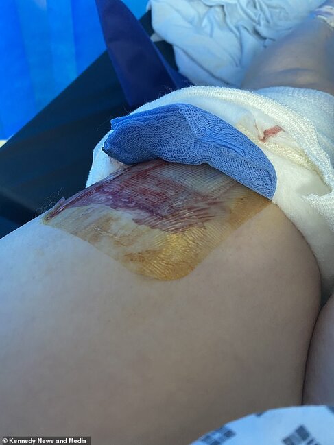 3 ay solariuma getdi, ayağındakı kiçik xal BU HALA DÜŞDÜ - DƏHŞƏTLİ FOTOLAR