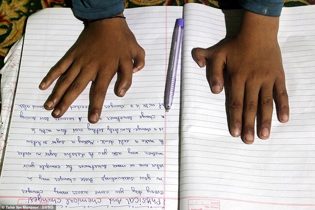 Bu oğlanın hər əlində 6 barmaq var - Bunun sayəsində o.... - FOTO-VİDEO