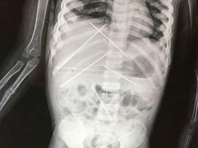 3 yaşlı qızın rentgen kağızı həkimləri dəhşətə gətirdi - FOTOLAR