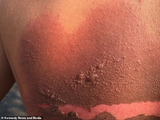 Telefonu şarja qoyub yuxuya gedən yeniyetmə BELƏ YANDI - FOTO+18