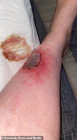 3 ay solariuma getdi, ayağındakı kiçik xal BU HALA DÜŞDÜ - DƏHŞƏTLİ FOTOLAR